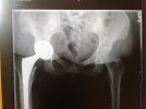 [Bonesmart.org] Day nine, graduated to crutch, staples gone