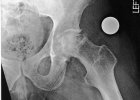 [Bonesmart.org] Eric's Hip Thread