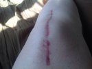 [Bonesmart.org] knee's recovery thread