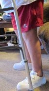 Conformis knee - a straighter leg?