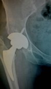 [Bonesmart.org] Czak's hip recovery