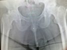 [Bonesmart.org] Tomorrow check in 7:45 am . 2nd hip replacement 12 weeks out