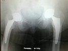 [Bonesmart.org] Tomorrow check in 7:45 am . 2nd hip replacement 12 weeks out