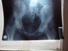 [Bonesmart.org] Help me please with my AVN