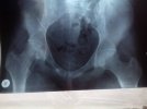 [Bonesmart.org] Help me please with my AVN