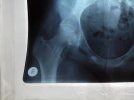 [Bonesmart.org] Help me please with my AVN