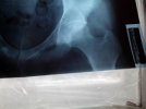 [Bonesmart.org] Help me please with my AVN