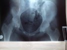 [Bonesmart.org] Help me please with my AVN