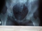 [Bonesmart.org] Help me please with my AVN