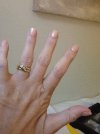 [Bonesmart.org] Infection, dislocation, revisions, & life beyond