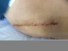 [Bonesmart.org] Infection, dislocation, revisions, & life beyond