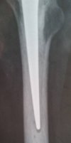 [Bonesmart.org] Living without a hip