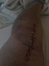 [Bonesmart.org] Madinana Made it to  knee #2