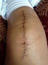 [Bonesmart.org] Loosening, RA  ?Second Revision