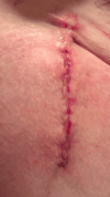 [Bonesmart.org] Anterior THR Aug 19, 2014 Home same day.