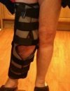 [Bonesmart.org] Wound infection
