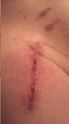 [Bonesmart.org] Anterior THR Aug 19, 2014 Home same day.