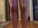 [Bonesmart.org] My Journey as of 12/16/13 - Over 1 Year and Still Trying