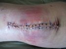 [Bonesmart.org] My Journey as of 12/16/13 - Over 1 Year and Still Trying