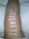 [Bonesmart.org] RTKR followed by Revision .  Now LTKR giving trouble.