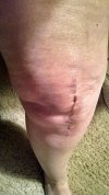 [Bonesmart.org] Revision Complete, recovery continues