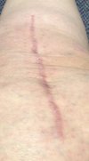[Bonesmart.org] Midwest Girl's New Knee Journey - A Year Later.