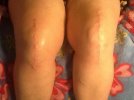 [Bonesmart.org] Puppylove's New Knees
