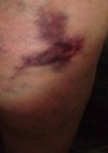 [Bonesmart.org] Midwest Girl's New Knee Journey - A Year Later.