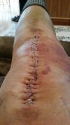 [Bonesmart.org] Knee Scars - Post Your Badges of Honor Here! NO CHIT-CHAT please