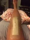 [Bonesmart.org] Knee Scars - Post Your Badges of Honor Here! NO CHIT-CHAT please