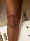 [Bonesmart.org] Knee Scars - Post Your Badges of Honor Here! NO CHIT-CHAT please