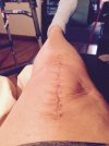 [Bonesmart.org] For Avascular Necrosis
