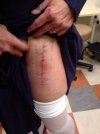 [Bonesmart.org] Hippies scars - post your badges of honor here: NO CHIT-CHAT HERE PLEASE