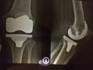 [Bonesmart.org] Still Riding the TKR Wave