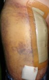[Bonesmart.org] Hippies scars - post your badges of honor here: NO CHIT-CHAT HERE PLEASE