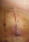 [Bonesmart.org] Hippies scars - post your badges of honor here: NO CHIT-CHAT HERE PLEASE