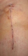 [Bonesmart.org] Hippies scars - post your badges of honor here: NO CHIT-CHAT HERE PLEASE