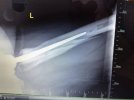 [Bonesmart.org] Meggzie is bilaterally bionic!