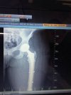 [Bonesmart.org] Meggzie is bilaterally bionic!