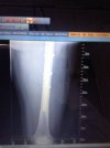 [Bonesmart.org] Meggzie is bilaterally bionic!