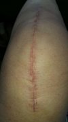 [Bonesmart.org] Karen's Journey with ConforMIS iTotal  January 20, 2015