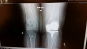 [Bonesmart.org] Karen's Journey with ConforMIS iTotal  January 20, 2015