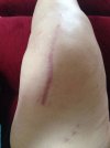 [Bonesmart.org] Bionic knee #2 done 1-21-15