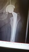 [Bonesmart.org] Recovery thread - starting at week three!