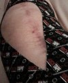 [Bonesmart.org] Recovering & Getting Ready for #2