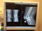 [Bonesmart.org] wberry's First Timers TKR Nervous Cat