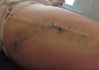 [Bonesmart.org] teenager hip replacement after SUFE