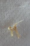 [Bonesmart.org] My new Right Hip