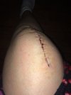 [Bonesmart.org] I just got my new knee.