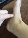 [Bonesmart.org] I just got my new knee.